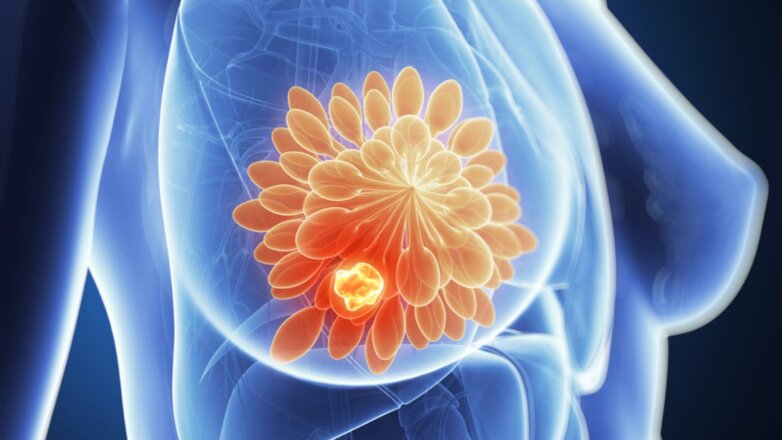 Британские учёные рассказали об опасности лекарств от рака груди