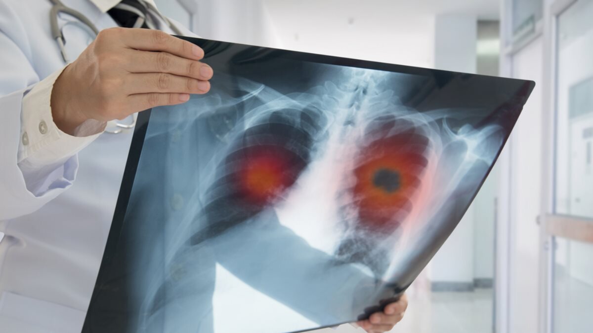 Рак лёгких рентгеновский снимок