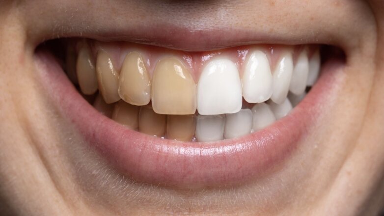 Учёные создали пептидный лак для защиты зубов от кариеса