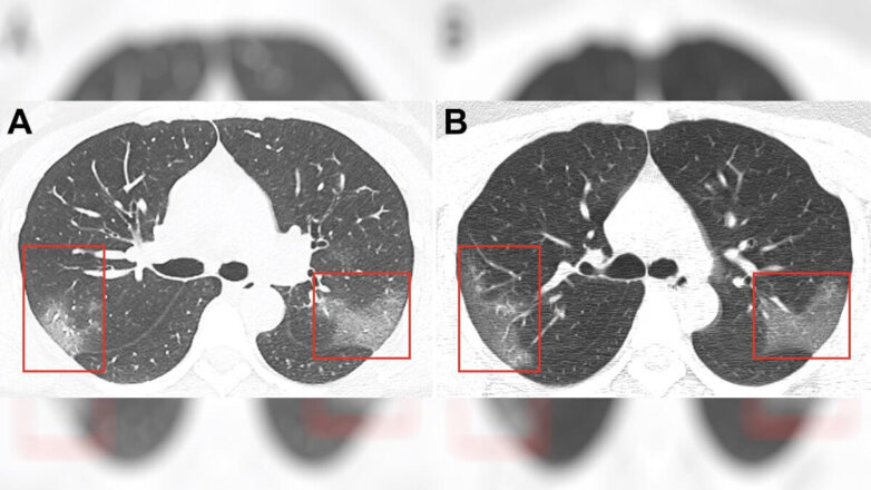 Китайские врачи показали снимки поражённых коронавирусом лёгких