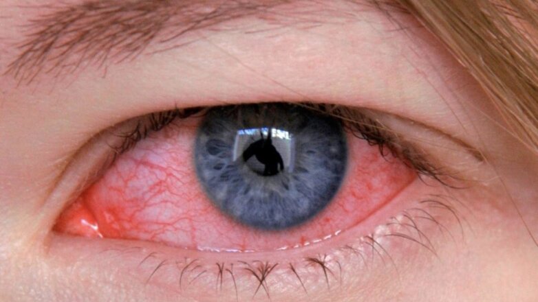 Медики предупредили о новом штамме неизлечимого глазного гриппа