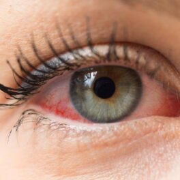 Качество зрения: 5 основных причин покраснения глаз