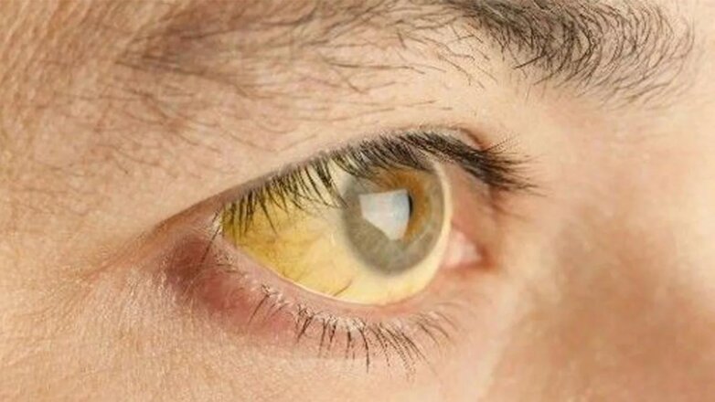 Необычный симптом опасного вида рака нашли в глазах