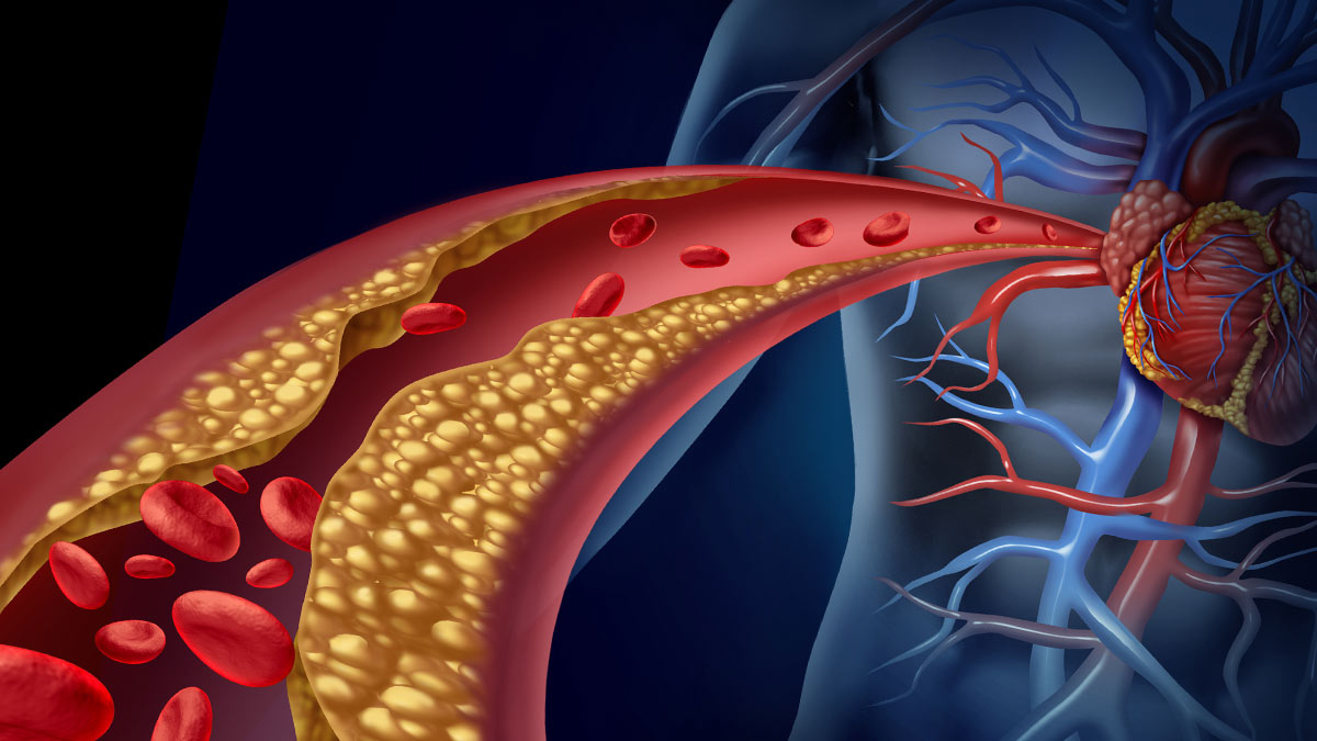 Холестерин атеросклероз кровеносная система сосуды артерии