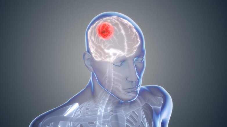 Врач раскрыл первые «тихие» симптомы опухоли мозга
