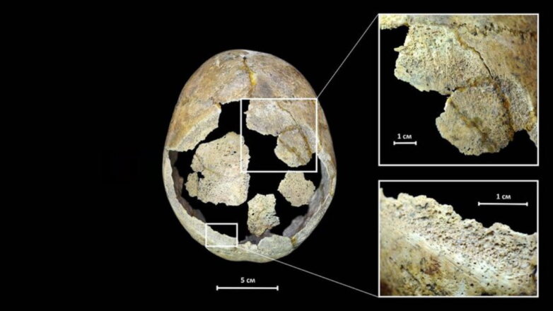 Археологи нашли череп 5000-летнего мужчины со следами операции на мозге