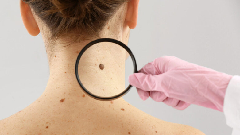 Названы симптомы редкого рака кожи, который быстро развивается без лечения
