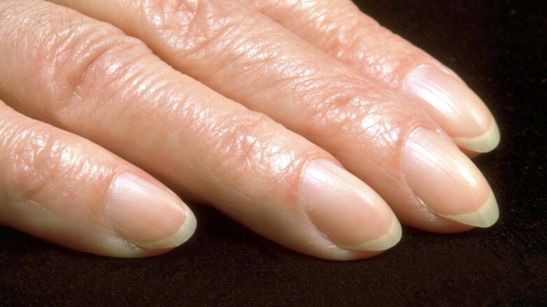 Проблему с пальцами назвали признаком злокачественной опухоли