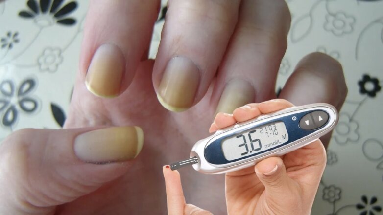 "Странную" проблему с ногтями назвали ранним признаком сахарного диабета