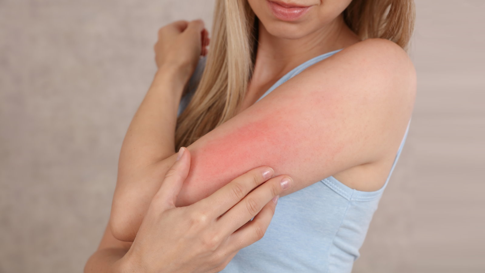 Аллергическое раздражение на коже