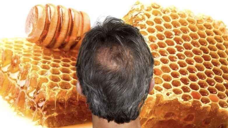 705943 выпадение волос и мед
