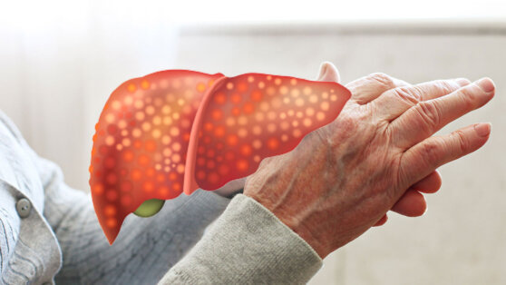 На жировую болезнь печени укажут четыре признака на руках