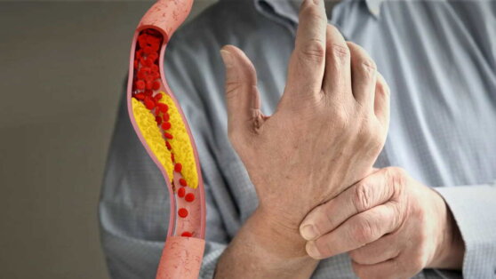 Симптомы высокого холестерина: пальцы рук могут сигнализировать об опасном состоянии