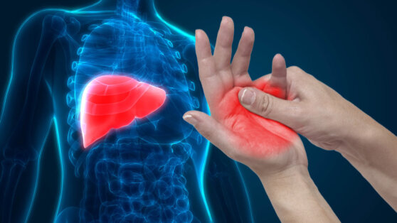 На жировую болезнь печени укажут четыре признака на руках