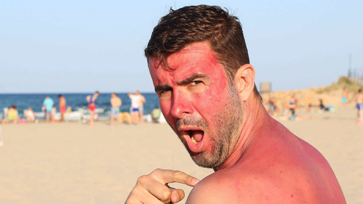 Обгорело лицо на солнце что делать. Обгоревшие на солнце люди на пляже. Загар вреден. Чел на пляже страдает.