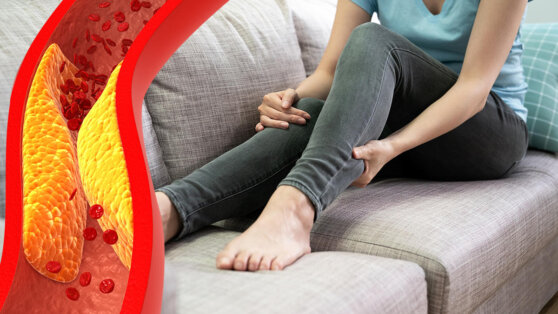 Последствия высокого холестерина: боль в ногах может указать на опасное состояние