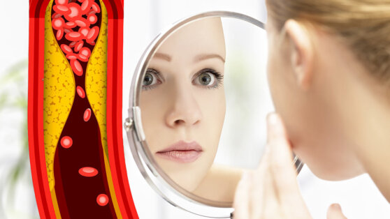 Высокий холестерин: симптом на коже предупредит о проблемах с сосудами