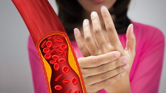 Высокий холестерин: три предупреждающих симптома на коже