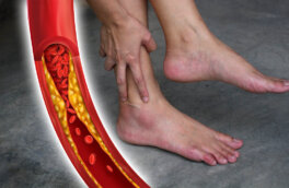 Высокий холестерин: 6 видимых признаков на ногах укажут на состояние