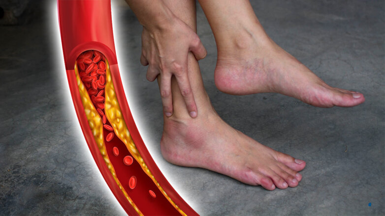 Высокий холестерин: 6 видимых признаков на ногах укажут на состояние