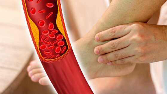 Высокий холестерин: чем он опасен для сухожилий