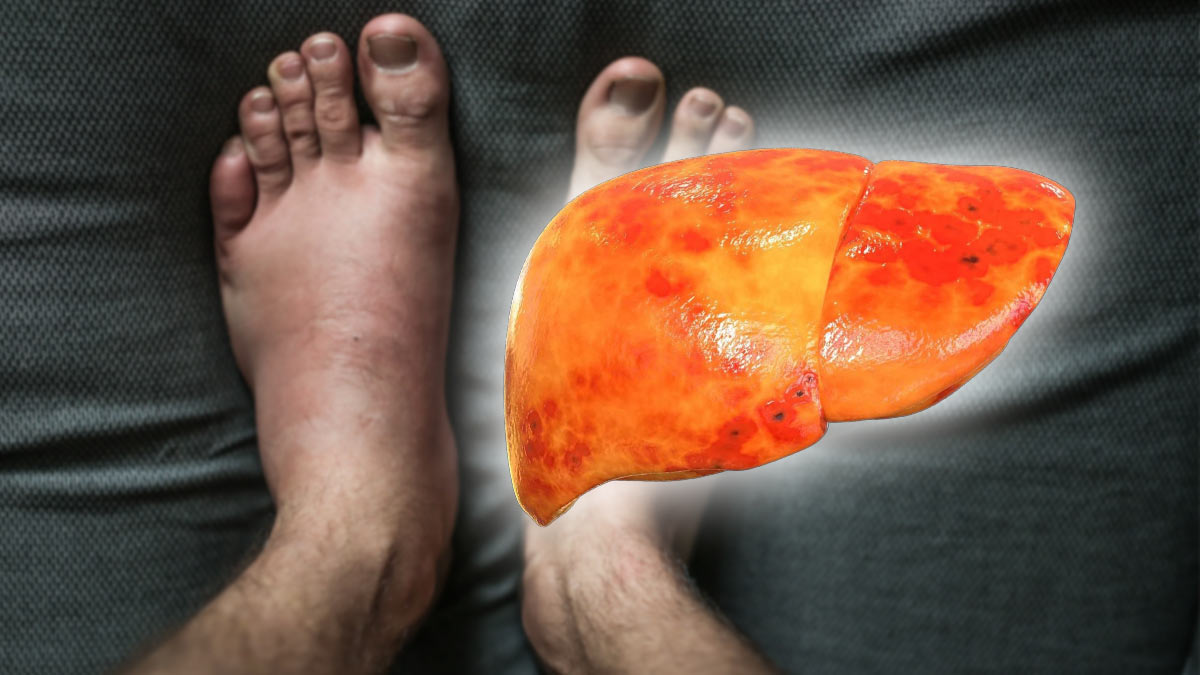 Жировая болезнь печени отеки на ногах