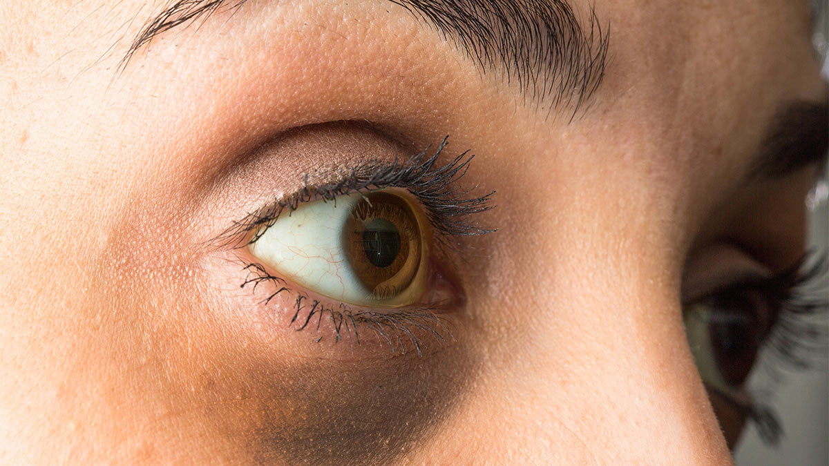 Качество зрения: почему белки глаз меняют цвет и когда это опасно