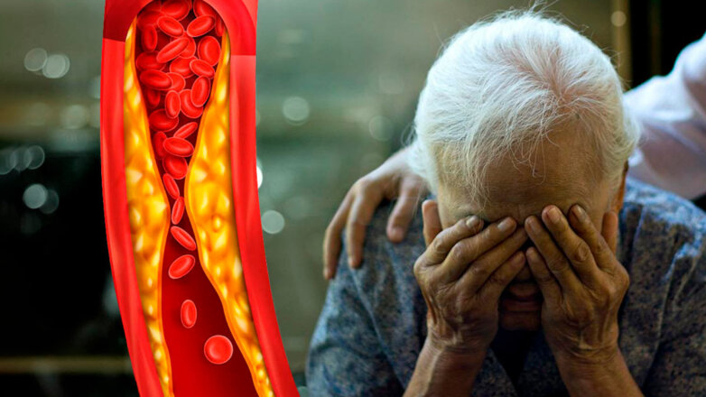 Ученые выяснили, что может защитить от болезни Альцгеймера