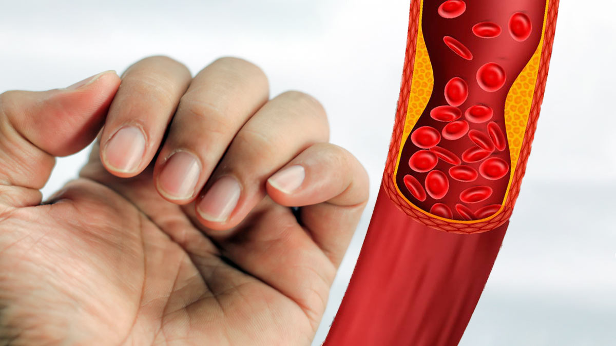 Цвет ваших ногтей может быть симптомом высокого холестерина