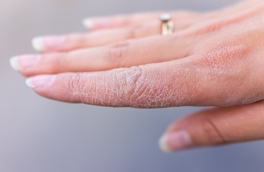 Простые способы решения проблемы: почему трескается кожа на руках и что с этим делать