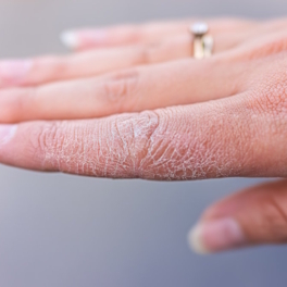 Простые способы решения проблемы: почему трескается кожа на руках и что с этим делать